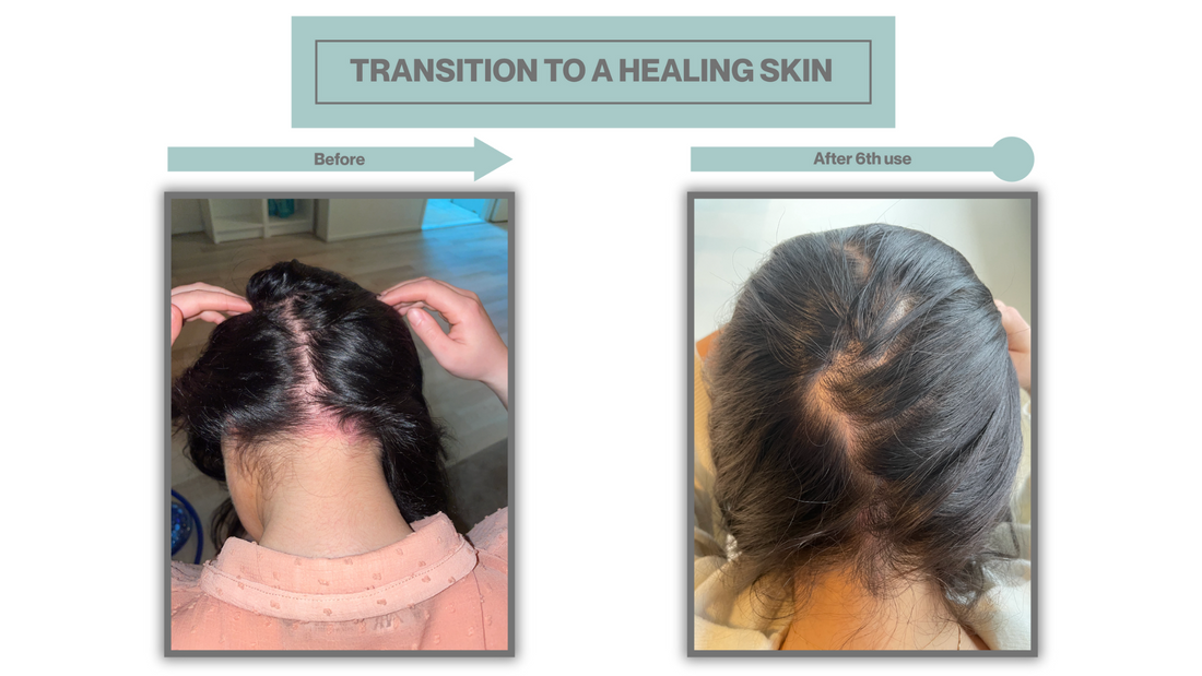 Gezonde hoofdhuid: 5 essentiële tips